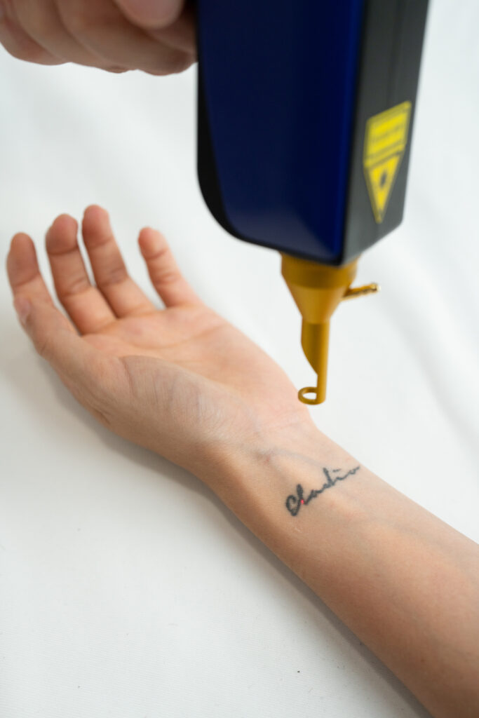 Eliminación de tatuajes y micropigmentación con láser Q-Switch en Derio
